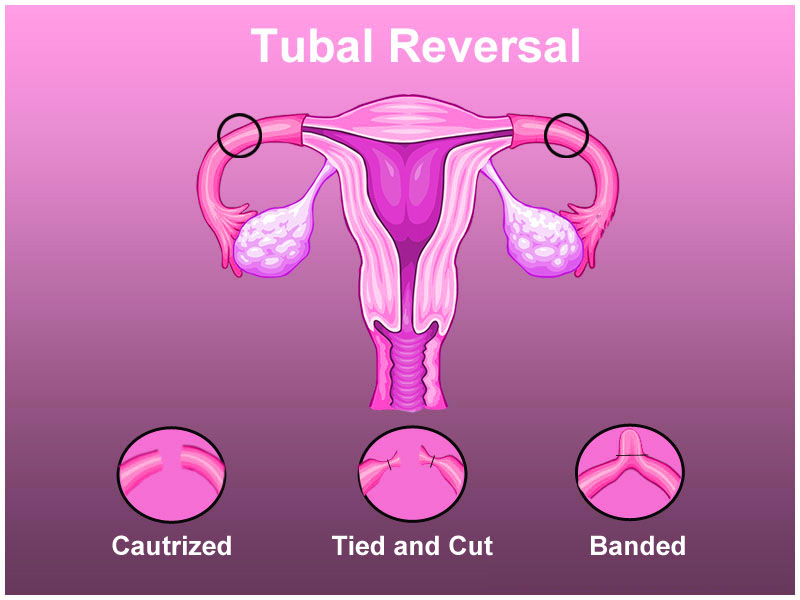 Tubal ligation reversal surgery