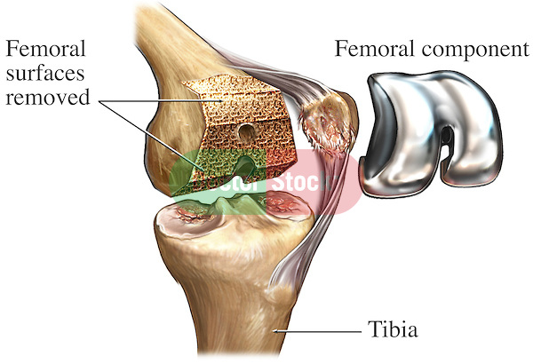Total Knee Joint Replacement Surgery. This illustration features a single surgical view of the bones of the left knee showing the placement of a femoral component in a knee replacement. Specifically labeled are; Femoral surfaces removed, femoral component and tibia.