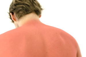 Sunburned male back. Isolated over white background.